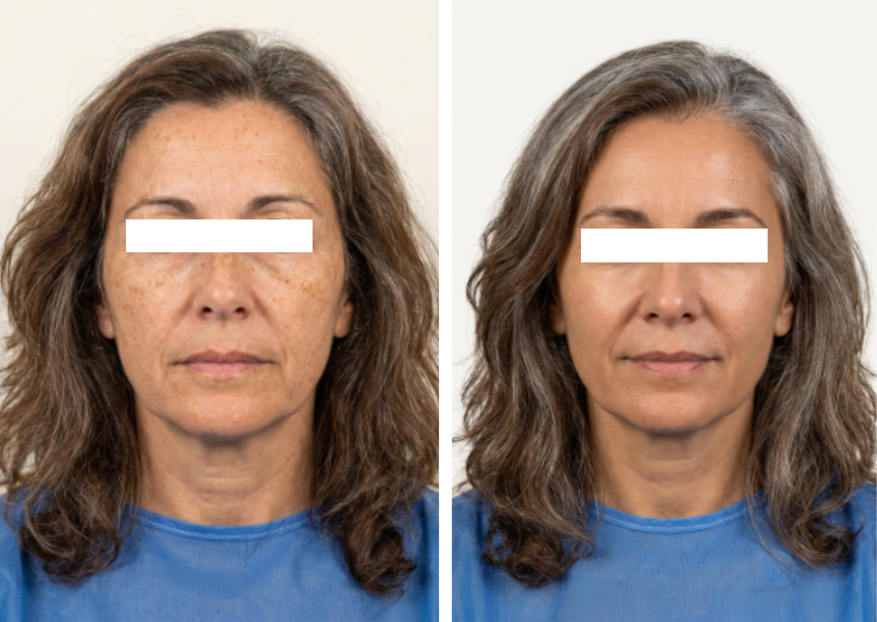 Peeling Químico Fenol